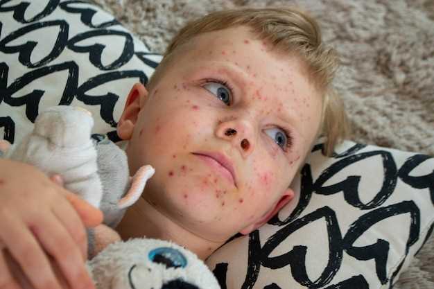 Как долго продолжается аллергическая сыпь у ребенка и как облегчить симптомы