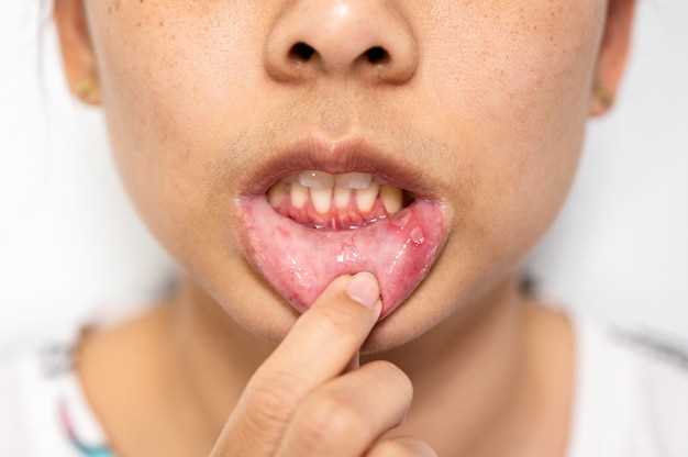 Описание шанкра во рту при сифилисе
